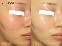 Velisse 表参道店【ヴェリス】《毛穴/肌質改善/ハーブピーリング/ニキビケア》/