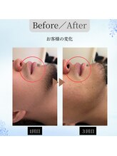 ミラ(Mira)/【メンズ】ヒゲ脱毛の変化