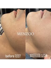 メンズー(MENZOO)/