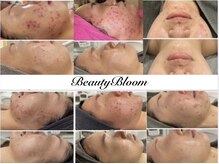 ビューティーブルーム(Beauty Bloom)の雰囲気（赤ニキビもしっかり鎮静させてニキビのない本気の肌質改善★）