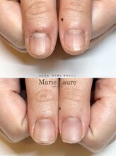 マリーロール 梅田店(Marie Laure)/自爪育成/深爪矯正/ネイルケア