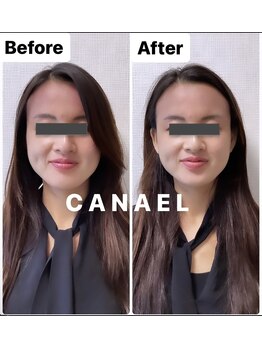 カナエル(CANAEL)/面長短縮/たるみ改善