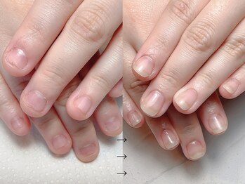 深爪矯正 自爪風長さ出し