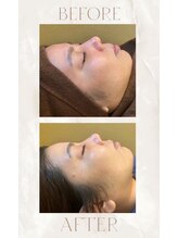 エムアイ 六本木(Mi)/水光ピール