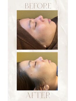 エムアイ 六本木(Mi)/水光ピール