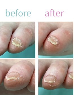 巻き爪補正店 富山店/副爪