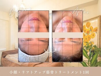 ハートフレンド(Heartfriend)/本格小顔コース1回