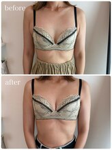 リノ 行橋(lino)/◇バストアップ症例◇40代