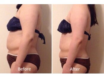 ルナ ボーテ(Lune Beaute)/上半身オーダーメイド6回