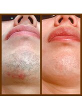 リアンジュ/ヒゲ脱毛の経過