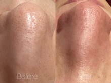 ビヨンド リンク(BEYOND L'INK)/韓国式3D毛穴洗浄