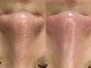 ヴィーヴ 京橋(vive)/【韓国式3D毛穴洗浄】