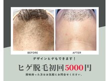 男のカラダビューティー/髭脱毛/髭デザイン