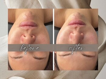 ゴールデンケア(goldencare)/フェイスライン・アゴ】改善希望