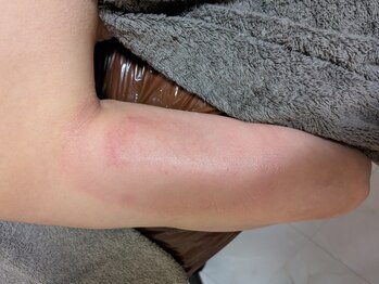 ひぺりかむ/【脂肪冷却施術後】後残り《六》