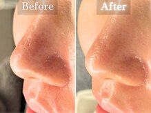 ボーンオム(Born Homme)/毛穴洗浄＋美容液導入：20代女性