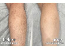 痛みや熱さが少ないのに、しっかり実感できる脱毛