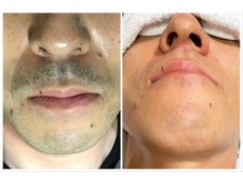 ヴァイオス 新宿店(VIOS)/◆ヒゲ脱毛【before/after】