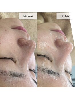 ヴィーナス(Venus)/エステ版ポテンツァ　3回