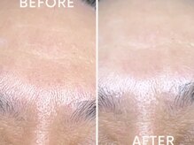 コハク(kohaku)/ララピール/ビフォーアフター