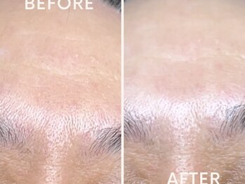 コハク(kohaku)/ララピール/ビフォーアフター