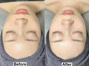 ドロップ 天王寺(DROP)/ララピール【艶肌/美白/くすみ】