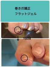 フットケアサロン ラビフット(Rabbi foot)/巻き爪ケアフラットジェル