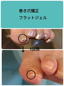 巻き爪ケアフラットジェル