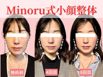 フレキシボディ(FlexiBody)/小顔施術ビフォーアフター #10