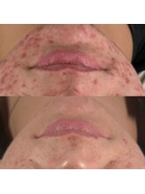 ソアン(Soin)/ハーブピーリング