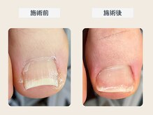 ルポ 伊勢/巻き爪ケア+爪ケア