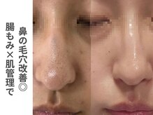 ソルレ 宮崎店(SOLURe)/鼻の毛穴改善 腸もみ×肌管理