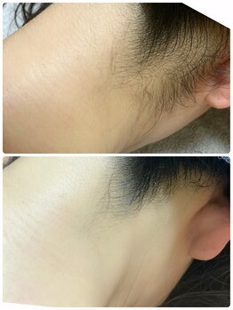 カルム(Calme)/うなじ脱毛