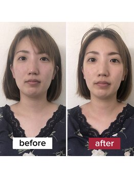 サロンチオリ 烏丸(Salon Chiori)/《40代》輪郭が締まる小顔矯正