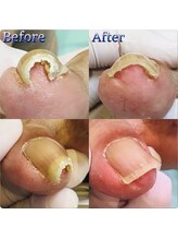 巻き爪補正店 湘南辻堂店/巻き爪・補正例