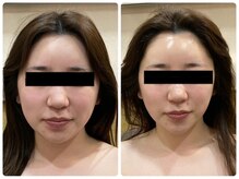 マリスレジーナ 新保店(MarisRegina)/ララピール　beforeafter