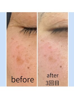 ミアローザ(Mia Rosa)/シミケア