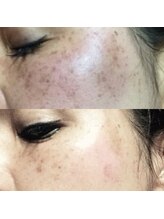 オードリリー(eau de Lily)/ハーブピーリングで肌改善♪