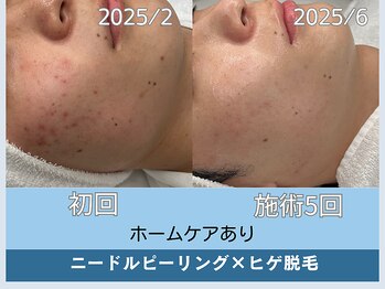 アロマ(AROMA)/ニキビ×ヒゲ脱毛が同時に叶う