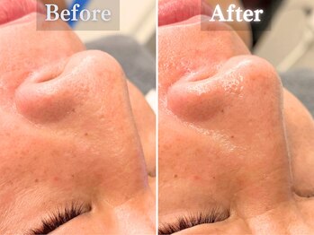 ボーンオム(Born Homme)/毛穴洗浄＋美容液導入：40代男性