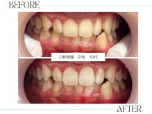 ホワイトニングサロンブライト 尼崎店(Whitening salon bright)/ご新規様のbefore/after
