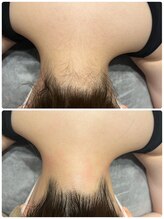 エイチビューティーラボ(h Beauty labo)/うなじ脱毛