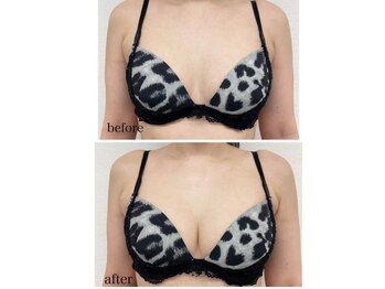 アファン 鶴見店(Afun)/バストアップBeforeAfter