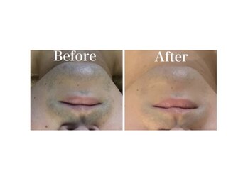 アブニールブリヨン/ひげ脱毛　Before After