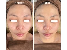 オレアグリーン 岡崎(OLEA green)/小顔矯正１回効果(リフトアップ)