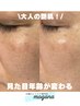 シミケア10分＋赤ちゃん肌ピーリング¥27,500→¥24,200