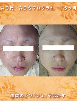 ナイア(naia)/リセラADS使用症例