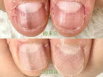 グラシナ 鳥丸店/伴走型深爪矯正