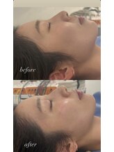 マホロバ(mahoroba)/ダーマ鍼＋幹細胞導入＋美容鍼