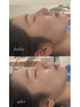 マホロバ(mahoroba)/ダーマ鍼+幹細胞導入+美容鍼